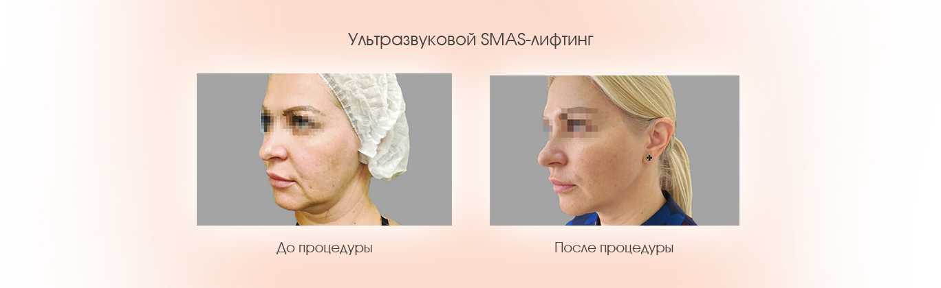 SMAS-лифтинг лица