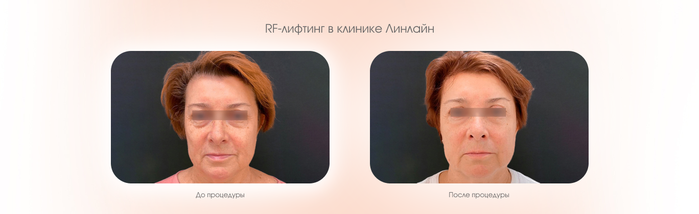 RF-лифтинг